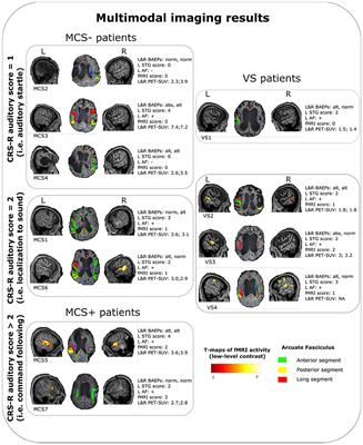 Preservation of Language Processing and Auditory Performance in Patients With Disorders of Consciousness: A Multimodal Assessment